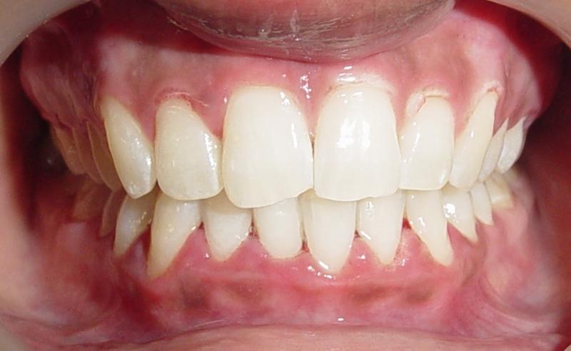 WHITENED WITH ZOOM ADANCED POWER