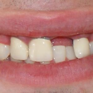 BROKEN TOOTH AND ANOTHER THREE ARE UNSTABLE DUE TO TRAUMA