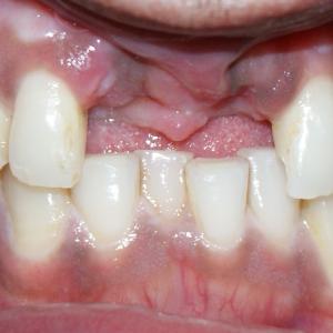 MISSING FRONT 2 TEETH