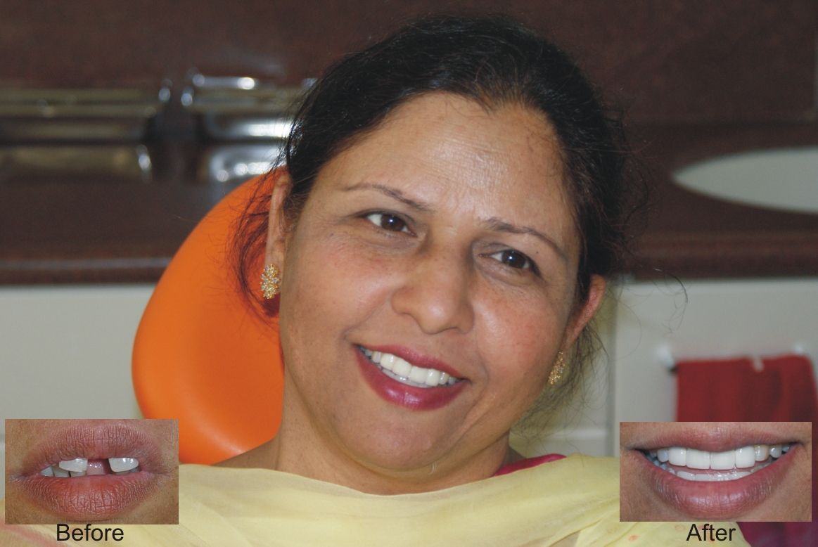 8 Dental Implants for 8 Missing Teeth