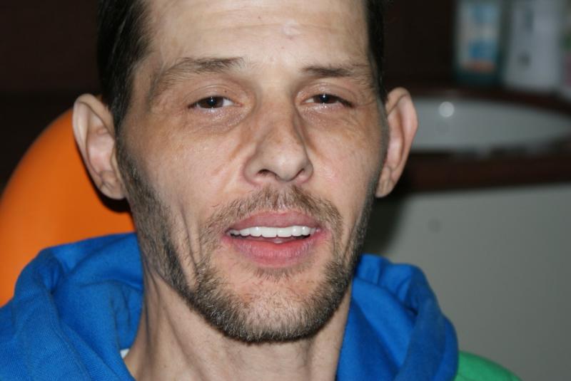  Jason from Australia full mouth implnats with nobel Active 