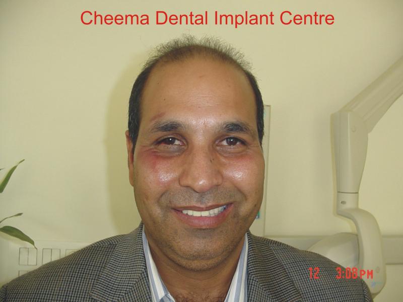 sukhdev thind front 2 immediate loading dental implants